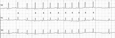 Cardiac Conduction System