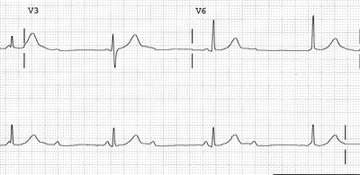 Cardiac Conduction System