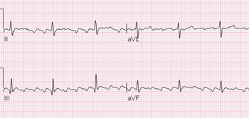 Cardiac Conduction System