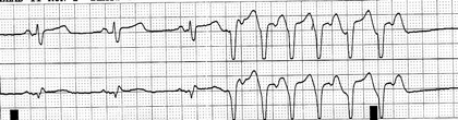 Cardiac Conduction System
