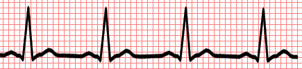 Normal Sinus Rhythm