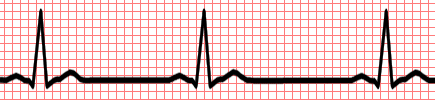 Sinus Bradycardia