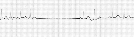 Cardiac Conduction System