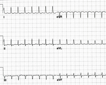 Cardiac Conduction System