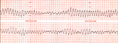 Cardiac Conduction System